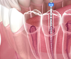 Endodontic